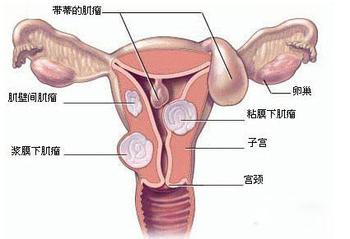 子宫肌瘤的预防