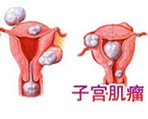 怎么预防子宫肌瘤