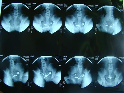 子宫输卵管造影检查结果